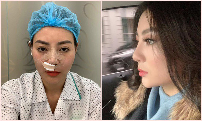 Sau Quỳnh búp bê, Thanh Hương Lan cave lộ ảnh phẫu thuật thẩm mỹ