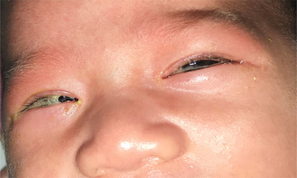 Em bé 2 tuần tuổi bị lây bệnh tình dục từ mẹ