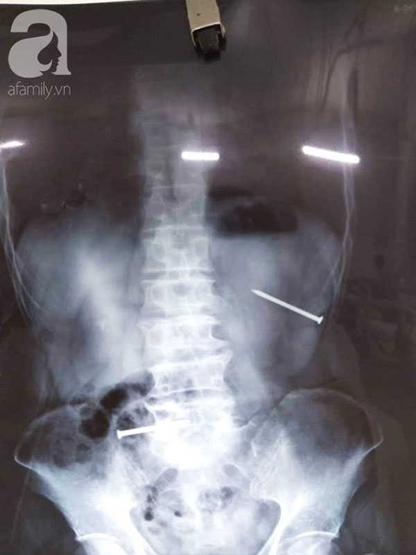 Tai nạn rợn người: Vấp té, người đàn ông bị đinh nhọn đâm từ rốn xuyên vào bụng