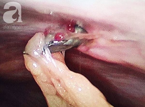 Tai nạn rợn người: Vấp té, người đàn ông bị đinh nhọn đâm từ rốn xuyên vào bụng