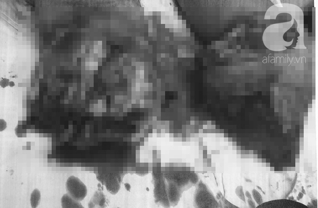 Tai nạn kinh hoàng: Ngã vào máy ép giấy đang hoạt động, nam thanh niên 24 tuổi bị đứt lìa hai đùi