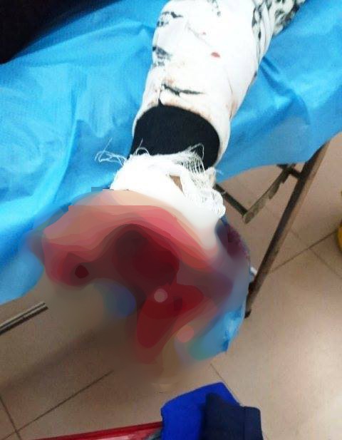 Vừa sạc vừa dùng điện thoại, thiếu niên 17 tuổi bị nát bàn tay