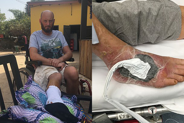 Rùng mình, bác sĩ thả 400 con giòi vào chân để ăn thịt chữa bệnh