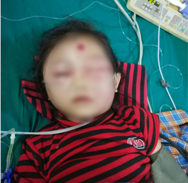 Bé gái 6 tuổi ở Phú Thọ suýt mất mạng chỉ vì nốt mụn nhỏ trên mặt