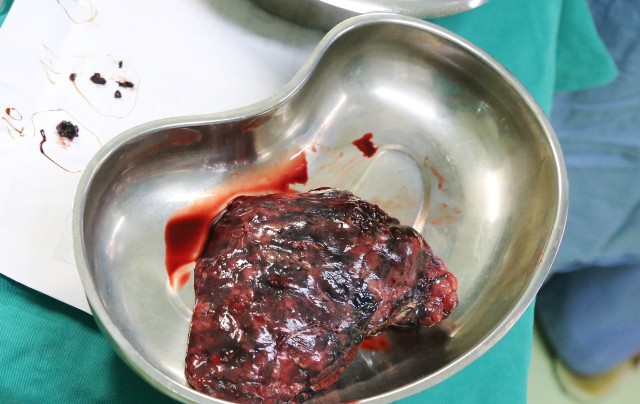 Cảnh báo ho khan 10 ngày, vào viện đã ung thư phổi