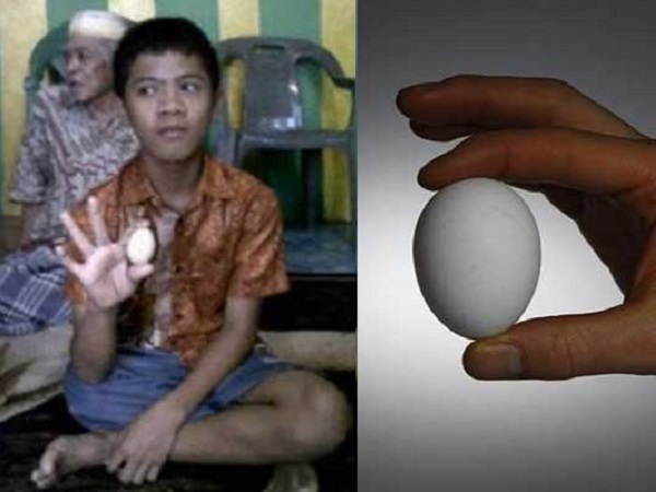 KHÓ TIN: Cậu bé người Indonesia đẻ 20 quả trứng đều đặn trong 2 năm