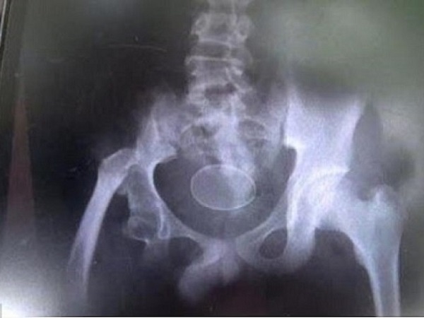 KHÓ TIN: Cậu bé người Indonesia đẻ 20 quả trứng đều đặn trong 2 năm