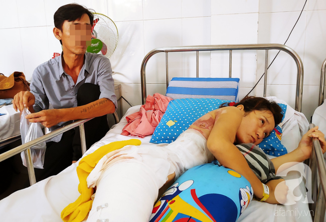 Vợ bị lửa xăng của chồng làm bỏng nặng sau cơn cuồng ghen: Em chỉ muốn làm lại từ đầu với anh ấy