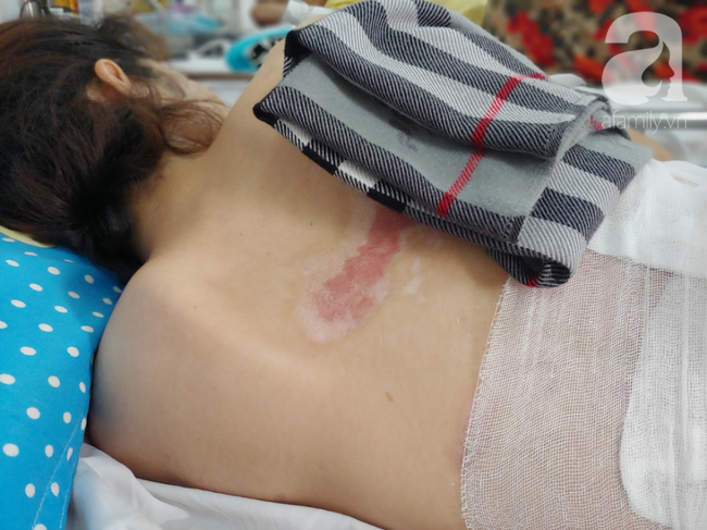 Vợ bị lửa xăng của chồng làm bỏng nặng sau cơn cuồng ghen: Em chỉ muốn làm lại từ đầu với anh ấy