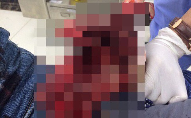 Đốt pháo không nổ, thanh niên ra cầm lên thì bị nổ nát bàn tay phải