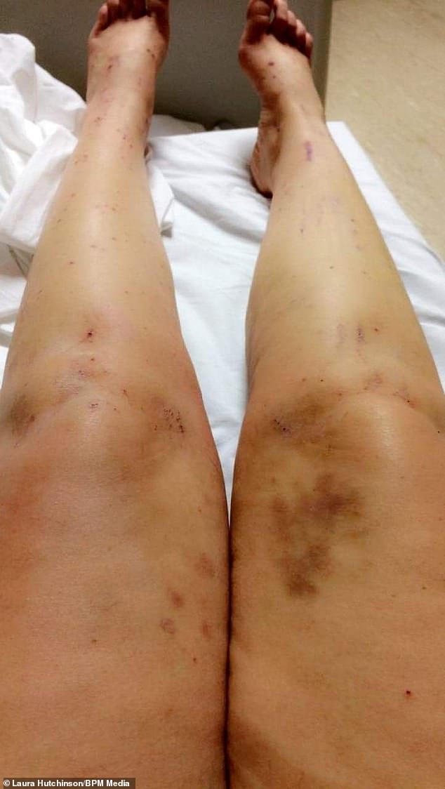 Lưu ý cho chị em: Uống thuốc tránh thai, bà mẹ này phải nằm viện 11 ngày, tổn thương gan, vàng mắt, vàng da...