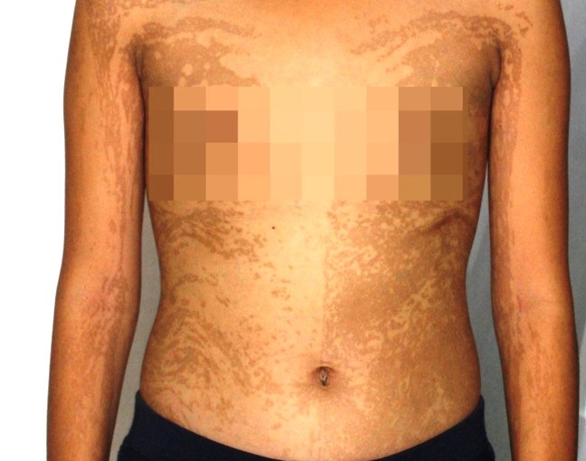 Bé gái An Giang là người đầu tiên trên thế giới mắc hai bệnh da hiếm gặp