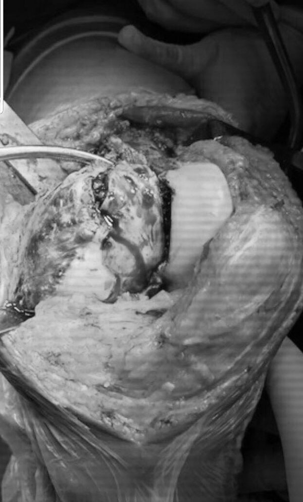 Nữ giáo viên 36 tuổi bị khối u ăn mục xương mà không biết