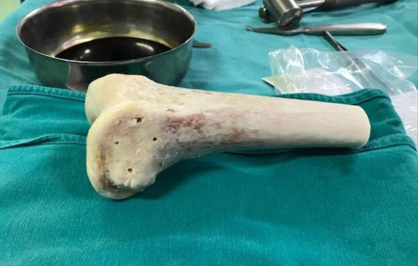 Nữ giáo viên 36 tuổi bị khối u ăn mục xương mà không biết