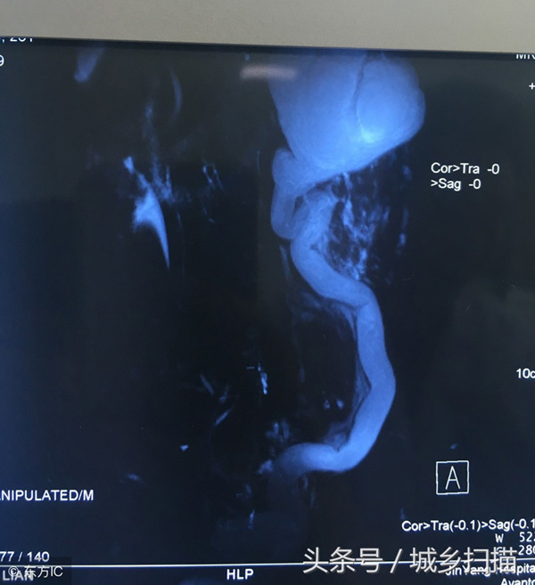 Nam thanh niên uống rượu thay nước lọc, đi khám phát hiện có 4 quả thận