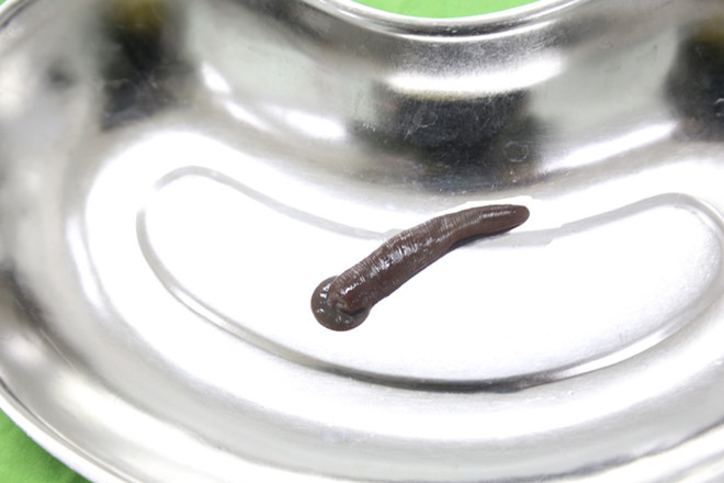 Đỉa trâu dài 10 cm sống nhiều ngày trong cổ họng bệnh nhân