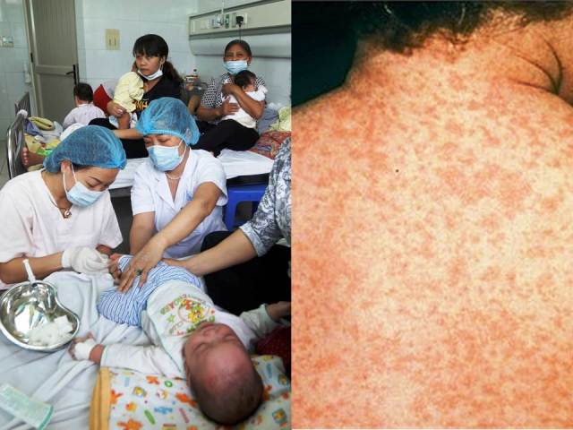 Hà Nội: Thêm 23 ca mắc sởi, không tiêm vắc xin dễ mắc bệnh