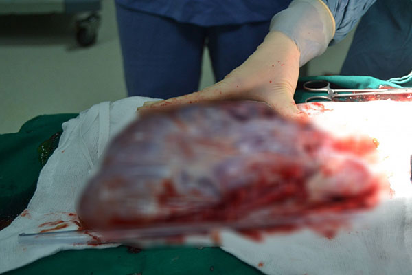 Người phụ nữ 61 tuổi bụng to như có bầu, bất ngờ khi nghe bác sĩ thông báo