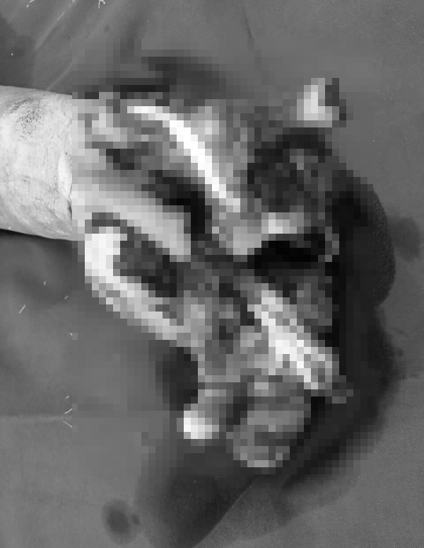 Ăn lẩu bằng bếp gas mini, nhiều người bị nổ nát tay