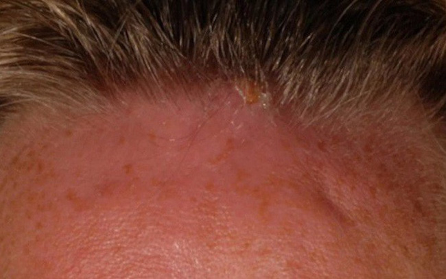 Giòi làm tổ trên trán người phụ nữ sau chuyến đi, chuyên gia cảnh báo bệnh dễ gặp khi đi du lịch