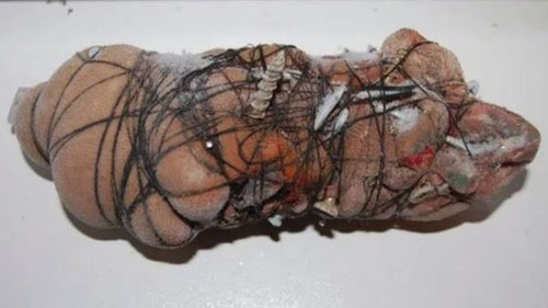 Người phụ nữ Anh bị truy tố vì cắt âm đạo của con gái