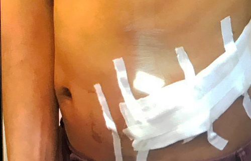 Hệ lụy sức khỏe của người bán thận kiếm tiền