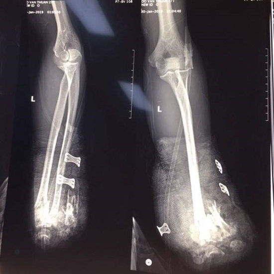 Tự chế pháo nổ, nam thanh niên bị cụt 2 bàn tay