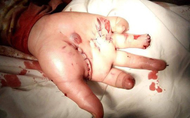 Hàng chục người ở Quảng Bình cấp cứu, có người bị mù do đốt pháo