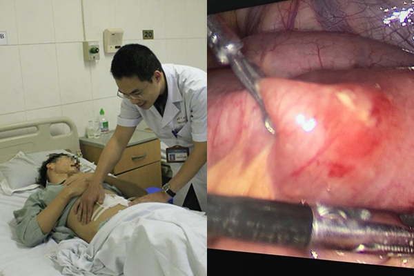 Thanh niên Hà Nội thủng ruột sau khi ăn cơm suất