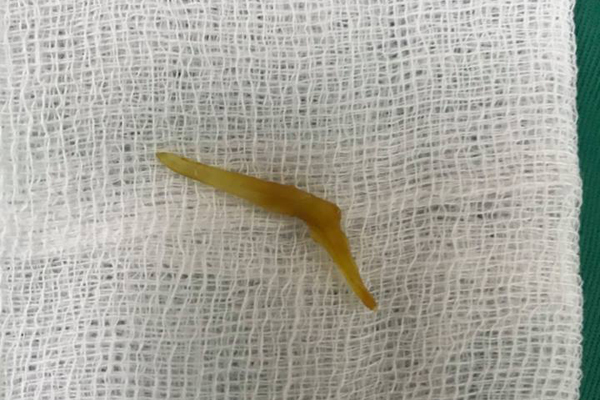 Thanh niên Hà Nội thủng ruột sau khi ăn cơm suất