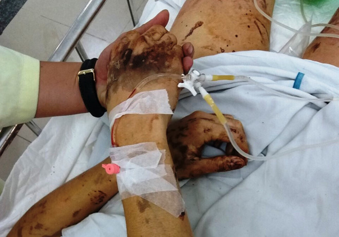 Truy tìm thủ phạm tạt axit vào đôi bạn Việt kiều về quê ăn Tết