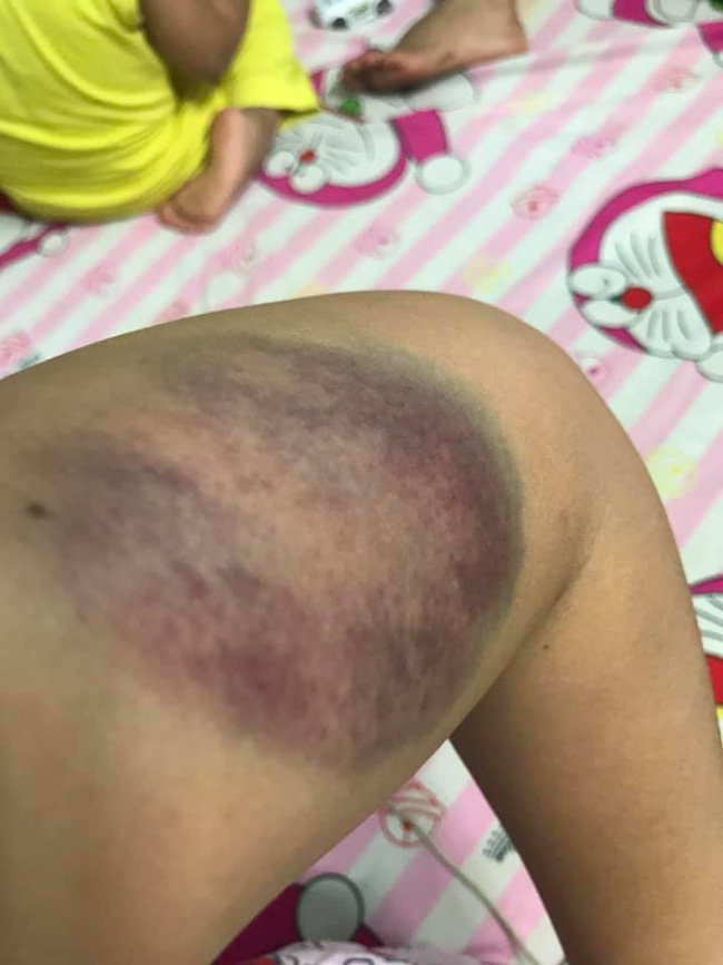 Kỷ niệm lễ Tình nhân, chồng đánh vợ mới sinh thừa sống thiếu chết phải nhập viện gây phẫn nộ cộng đồng mạng Kỷ niệm lễ Tình nhân, chồng đánh vợ mới sinh thừa sống thiếu chết phải nhập viện gây phẫn nộ cộng đồng mạng