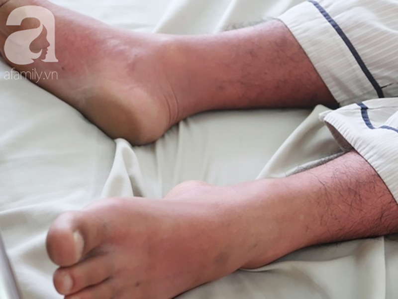 Dịch sởi đang diễn biến bất thường nhưng nhiều bà mẹ vẫn anti vaccine: Coi chừng mất mạng con