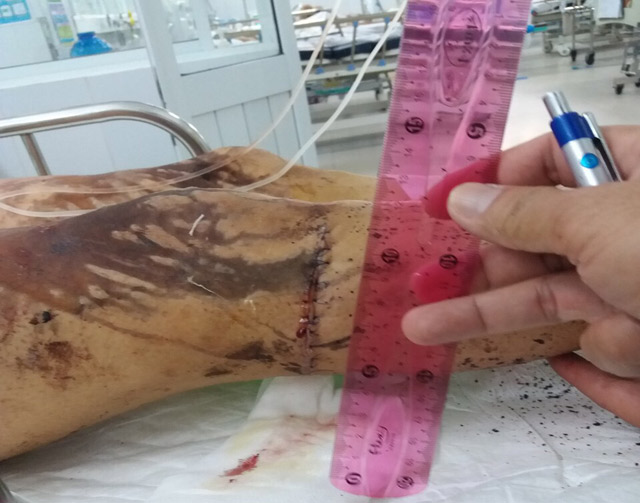 Cha Việt kiều bị tạt axit nói gì về nghi vấn người anh rời quê sớm?