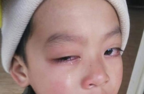 Giáo viên bị tố cáo đánh tổn thương mắt học sinh lớp 1