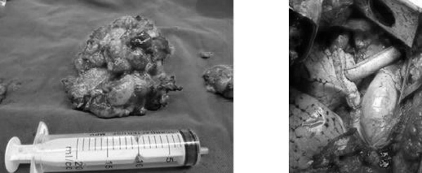 Đau vai gáy 6 năm, nữ thợ may Hưng Yên không ngờ nguy kịch