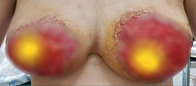 Cộng đồng chị em xôn xao với ca treo ngực thất bại tại spa với giá 15 triệu: Ngực hoại tử, lở loét kinh hoàng