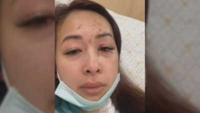 Tin mới nhất về vụ Việt kiều Canada bị tạt axit, cắt gân