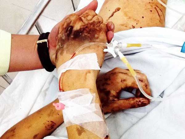 Nhận định mới trong vụ tạt axit, cắt gân chân Việt kiều vào mùng 5 Tết