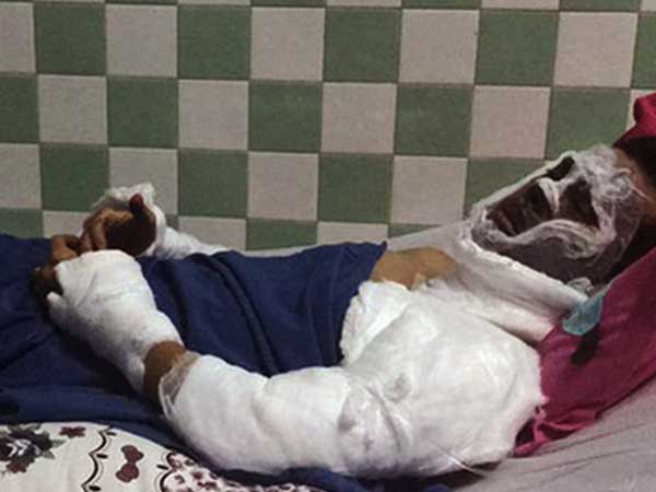 Việt kiều bị tạt a xít ở Quảng Ngãi bị cháy giác mạc