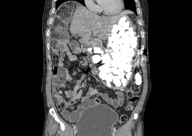 Đau bụng dữ dội vì 2 kg đá, đồng xu mắc kẹt trong dạ dày