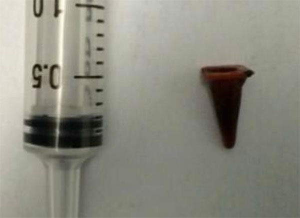 Người đàn ông bị chẩn đoán ung thư phổi, thủ phạm khiến nhiều người bất ngờ