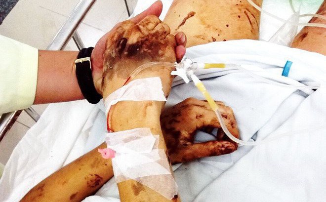 Vụ nam Việt kiều bị tạt axit, cắt gân chân ở Quảng Ngãi: Anh trai nạn nhân khóa số điện thoại và cả email sau khi trở về Canada