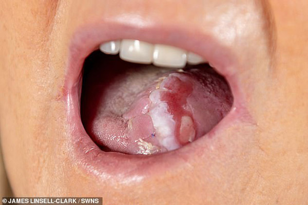 Người phụ nữ mắc ung thư được cứu sống nhờ lưỡi mới tạo ra trên cánh tay