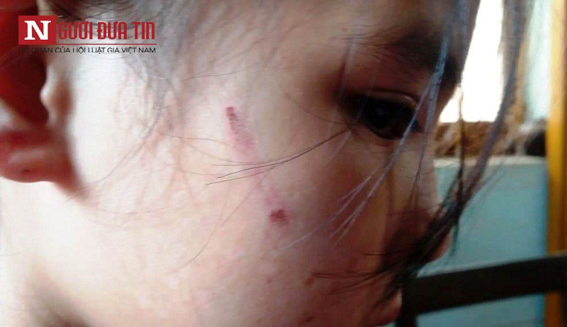 Hàng xóm kể lại giây phút giải cứu bé gái 8 tuổi bị bố nghiện ma túy đánh đập dã man