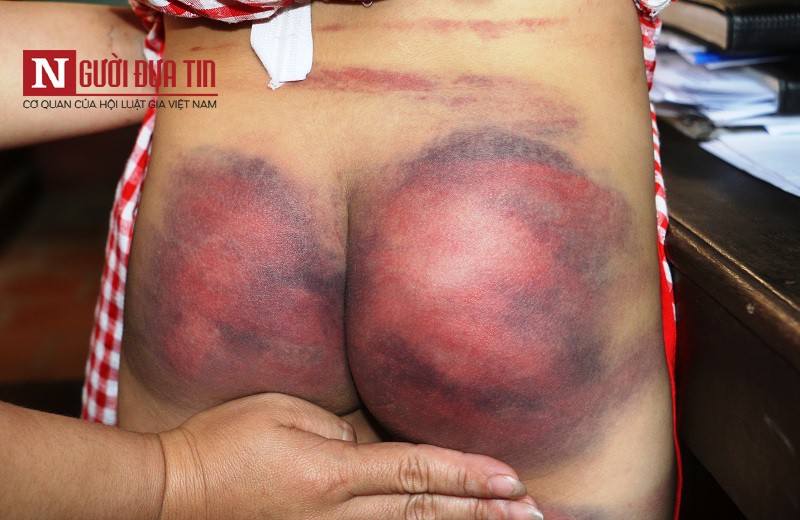 Hàng xóm kể lại giây phút giải cứu bé gái 8 tuổi bị bố nghiện ma túy đánh đập dã man