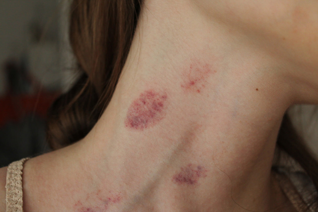 Cô gái 16 tuổi tử vong vì vết hôn cổ của bạn trai