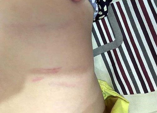 Bé trai bị cô giáo đánh, phụ huynh đòi trường bồi thường 100 triệu