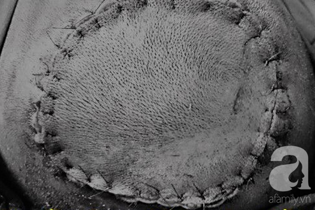 Đang chạy chơi trong nhà, bé gái 10 tuổi bị cuốn tóc vào máy xay tiêu lóc nát da đầu