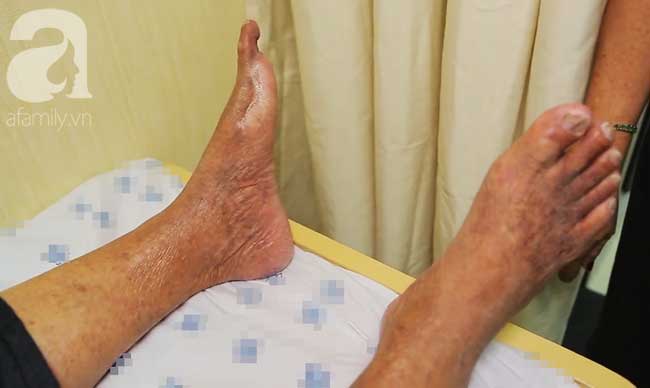 Nghĩ bị nhiễm trùng nặng do mang dép kẹp, đến khi đi khám bệnh người phụ nữ này mới tá hỏa vì mắc phải căn bệnh nguy hiểm